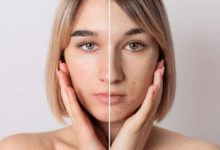 Best Ways to Remove Dark Spots on Face