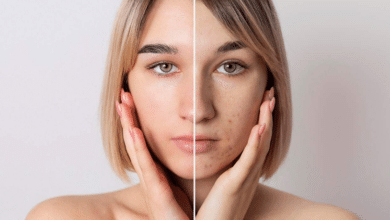 Best Ways to Remove Dark Spots on Face